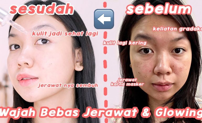 Perawatan Jerawat