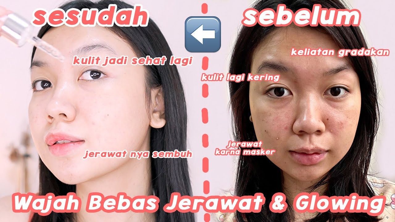 Perawatan Jerawat